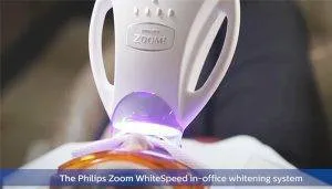 Tẩy trắng răng tại nhà