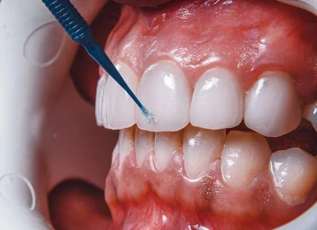 Răng sâu bị vỡ