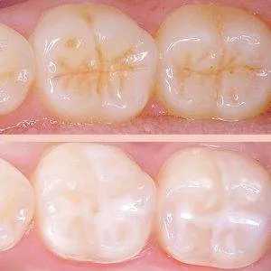 Dental Sealants 300x300