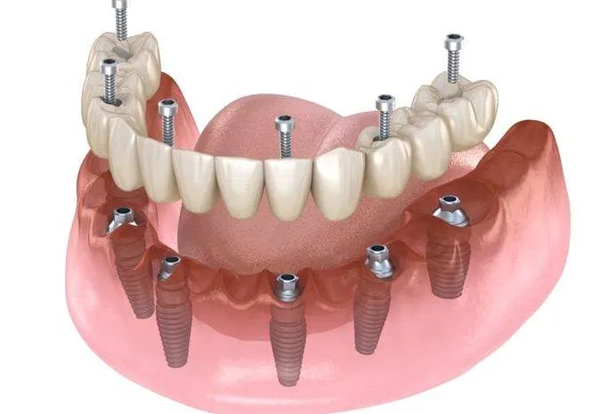 Cấy ghép implant All-On-6