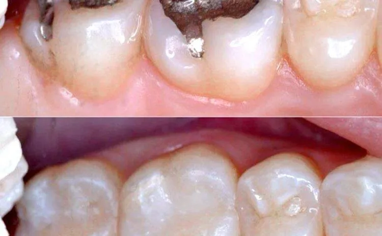 Trám răng Composite