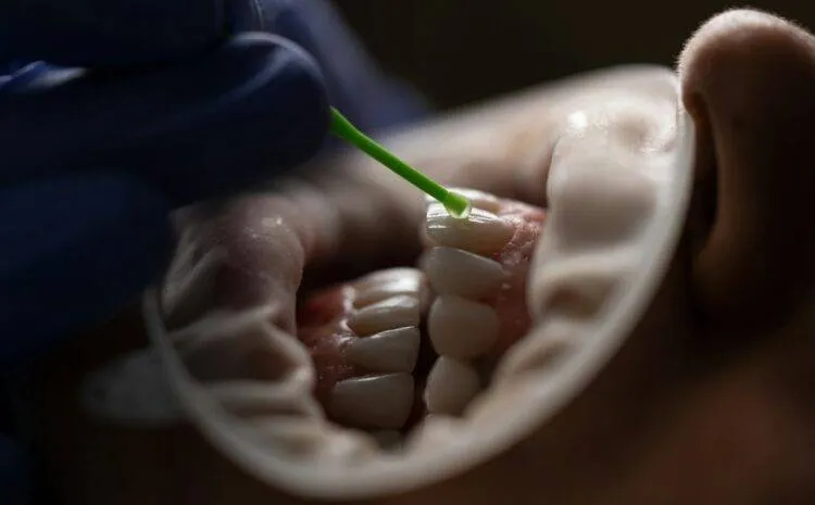 Răng sứ Cercon HT