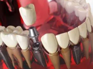 Implant 8 300x225