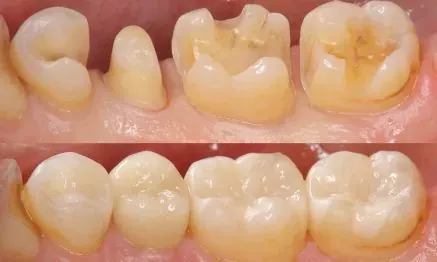 Trám Inlay/Onlay sứ