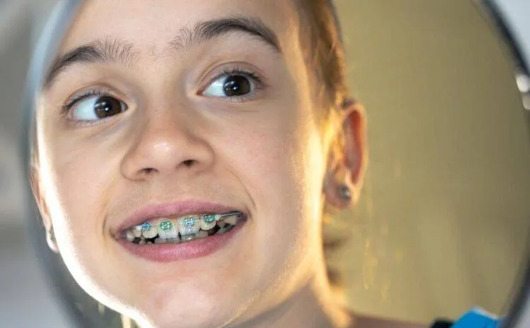 Niềng răng có làm thay đổi khuôn mặt?