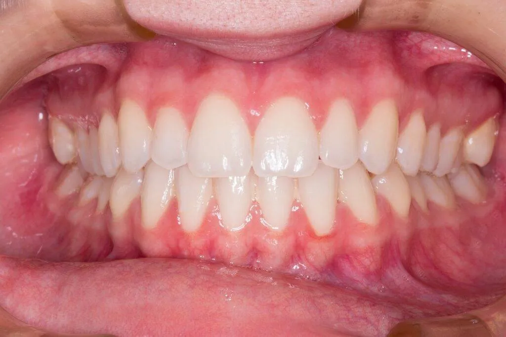 Rang Su Ceramill 2 1024x683