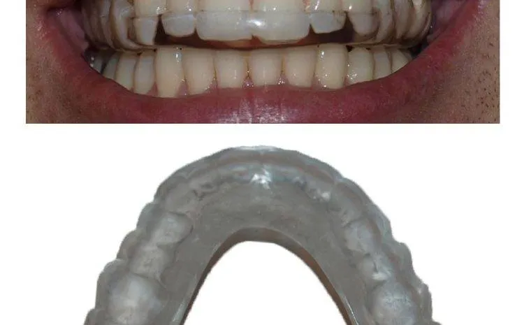 Điều trị chứng nghiến răng