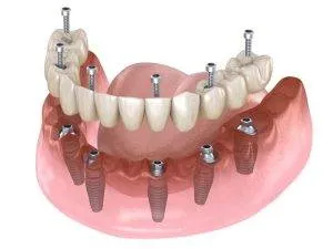 All on 6 Dental Implants 300x225