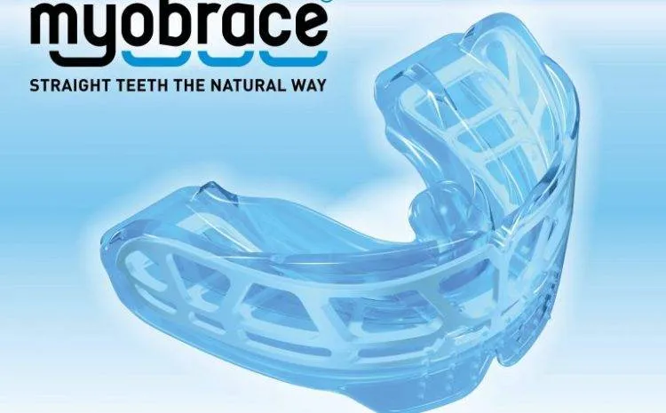 Myobrace 1 750x465
