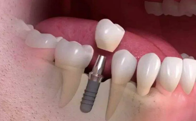Cấy ghép nha khoa Mini Implant
