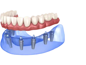 Phuc Hinh Toan Ham Tren 6 300x225