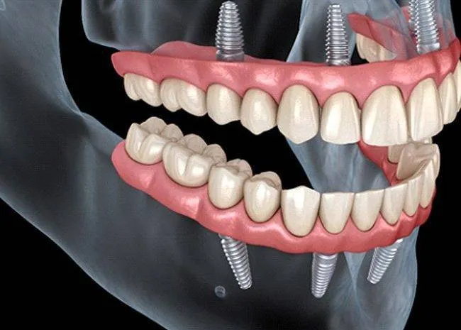 Cấy ghép implant All-On-4