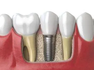 Implant 2 1 300x225
