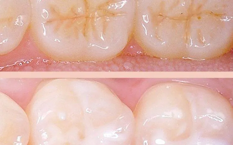 Trám bít hố rãnh