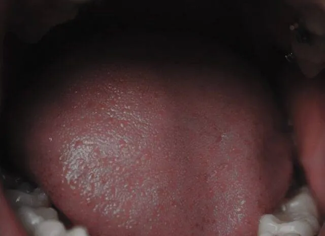 Các Loại Niềng Răng