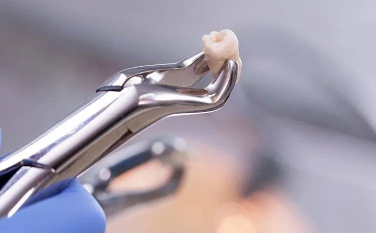 Nhổ răng tại Sakura: An toàn, không đau